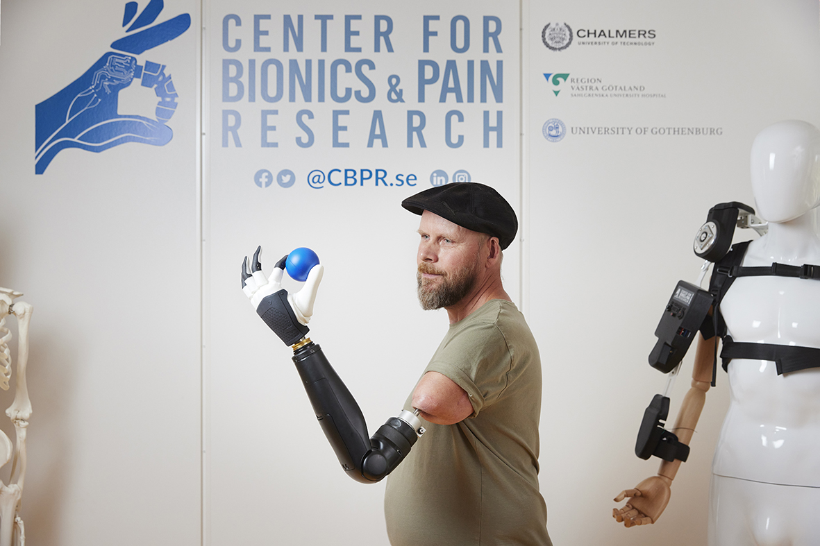 Cutting-edge surgical and engineering innovations enable unprecedented  control over every finger of a bionic hand